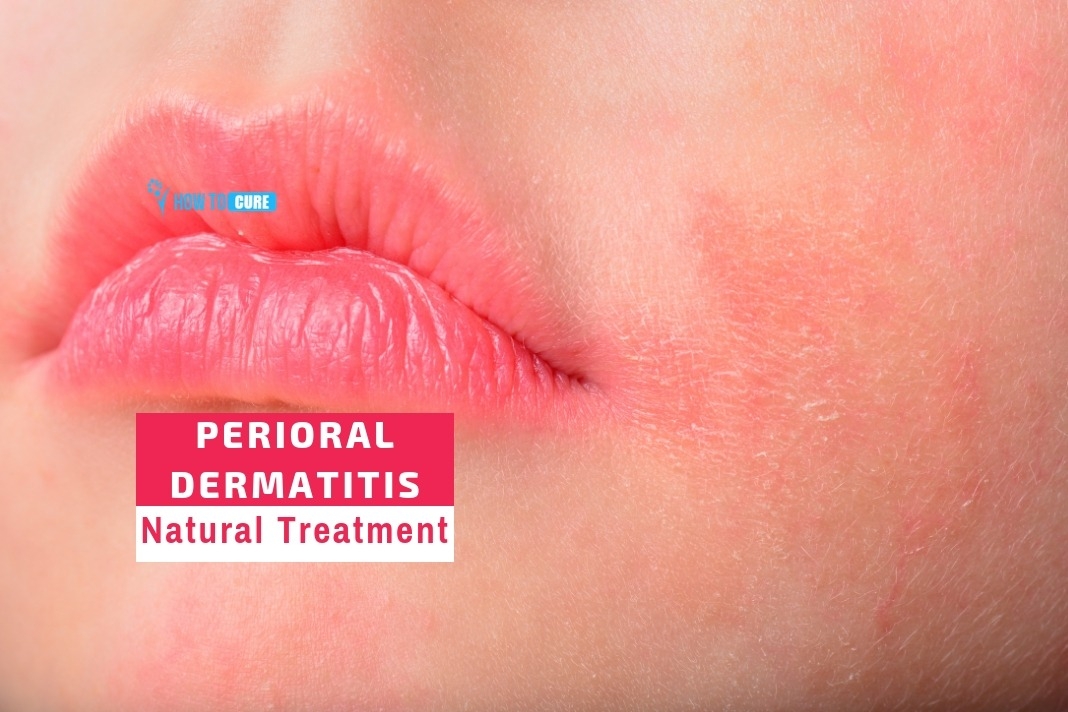 perioral dermatitis natural treatment