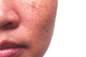 
    Can you clear melasma naturally?