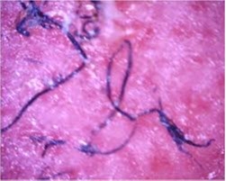 Morgellons Disease from a Natural Medicine Standpoint